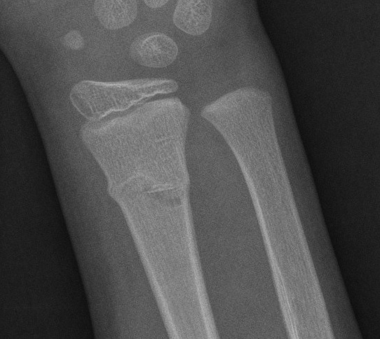 Greenstick Fracture AP